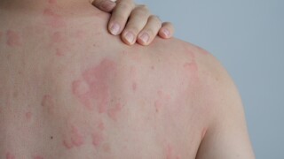 Close up image of skin texture suffering severe urticaria or hives 